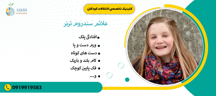 علائم سندروم ترنر